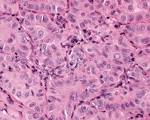 <b>papillary carcinoma</b> can be
