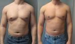 <b>Gynecomastia</b>-Male Breast