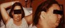 What does <b>Hyperandrogenism</b>