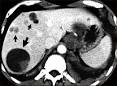 TC de <b>equinococosis</b> en el