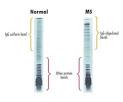 <b>Oligoclonal bands</b> in multiple