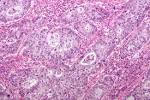 File:<b>Adenosquamous carcinoma</b>