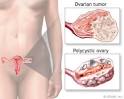 Celiac Sprue Disease Photos and a listing of clinical trials
