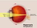 Farsightedness (Hyperopia) - Symptoms and Treatments for ...