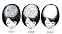Female hair loss | Female baldness