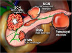 The Radiology Assistant : Pancreas - <b>Cystic</b> Lesions