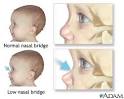 How Williams Syndrome is