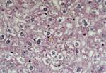 11: Presencia de <b>colestasis</b> en
