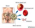 Bone-marrow transplant - series: MedlinePlus Medical Encyclopedia