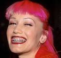 gwen stefani braces. 2 of 11