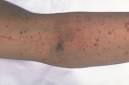 What Is Immune Thrombocytopenia? - NHLBI, NIH