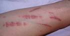 cutting (trigger warning) « Abagond