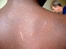 Hiv Rash African American Skin S And Pictures, Photos, Images ...