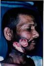 How To Quit Chewing - Quit Smokeless Tobacco Today!