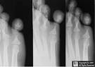 <b>Ainhum</b>; Ewing's sarcoma