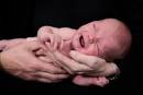 La sindrome da <b>aspirazione di</b>