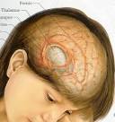 WARNING: BRAIN TUMOR HEADACHES ! Brain Tumor And Headaches Guide!