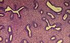 <b>Hiperplasia</b> del endometrio.