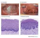 Figure 1 : Profiling early head and neck cancer : Nature Reviews ...