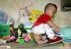 a chinese baby with a third leg