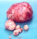 Resource Directory for information on uterine <b>myoma</b> (
