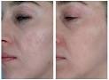 Dermabrasion in Brooklyn, New York, New Jersey and Long Island ...