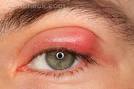 Stye <b>eye infection</b>