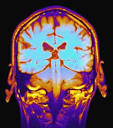 <b>Memory Disorders</b>: CNL @ Temple