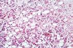 File:<b>Alcoholic hepatitis</b>.jpg
