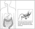 What I need to know about Diverticular Disease - National ...