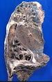 Bronchiectasis - Wikipedia, the free encyclopedia