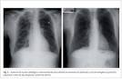 a <b>disfunção ventricular</b>