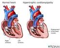 Hypertrophic cardiomyopathy is
