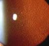 <b>endothelial dystrophy</b>