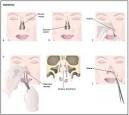 Septoplasty   procedure recovery blood removal pain