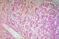 <b>alcoholic</b>-<b>hepatitis</b>-<b>hepatitis</b>-