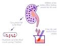 Types of <b>Nephrotic Syndrome</b>