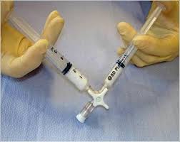 Foam Sclerotherapy Treatment 