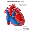 a patent <b>ductus arteriosus</b>
