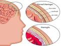 Bacterial Meningitis Symptoms | My Health Blogs