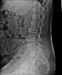 <b>Diffuse idiopathic skeletal</b>