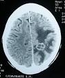 Cerebral edema - Wikipedia, the free encyclopedia