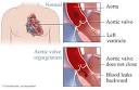 Aortic valve regurgitation: Healthwise Medical Information on ...