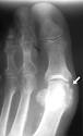 Appendicular <b>Arthritis</b> — UW Radiology