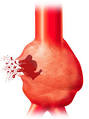 What is Abdominal Aortic Aneurysm? | Treating Aortic Stents with