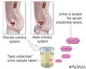 <b>Creatinine</b> urine test