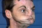 receives face transplant
