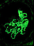 Levy: <b>Anti</b>-<b>Glomerular Basement</b>