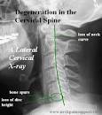 Neck Pain Support Blog: Dissecting Spinal Degeneration in the Neck