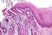 The <b>metaplastic</b> epithelial is